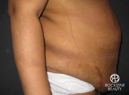 Tummy Tuck: Patient 8 - Before and After 2