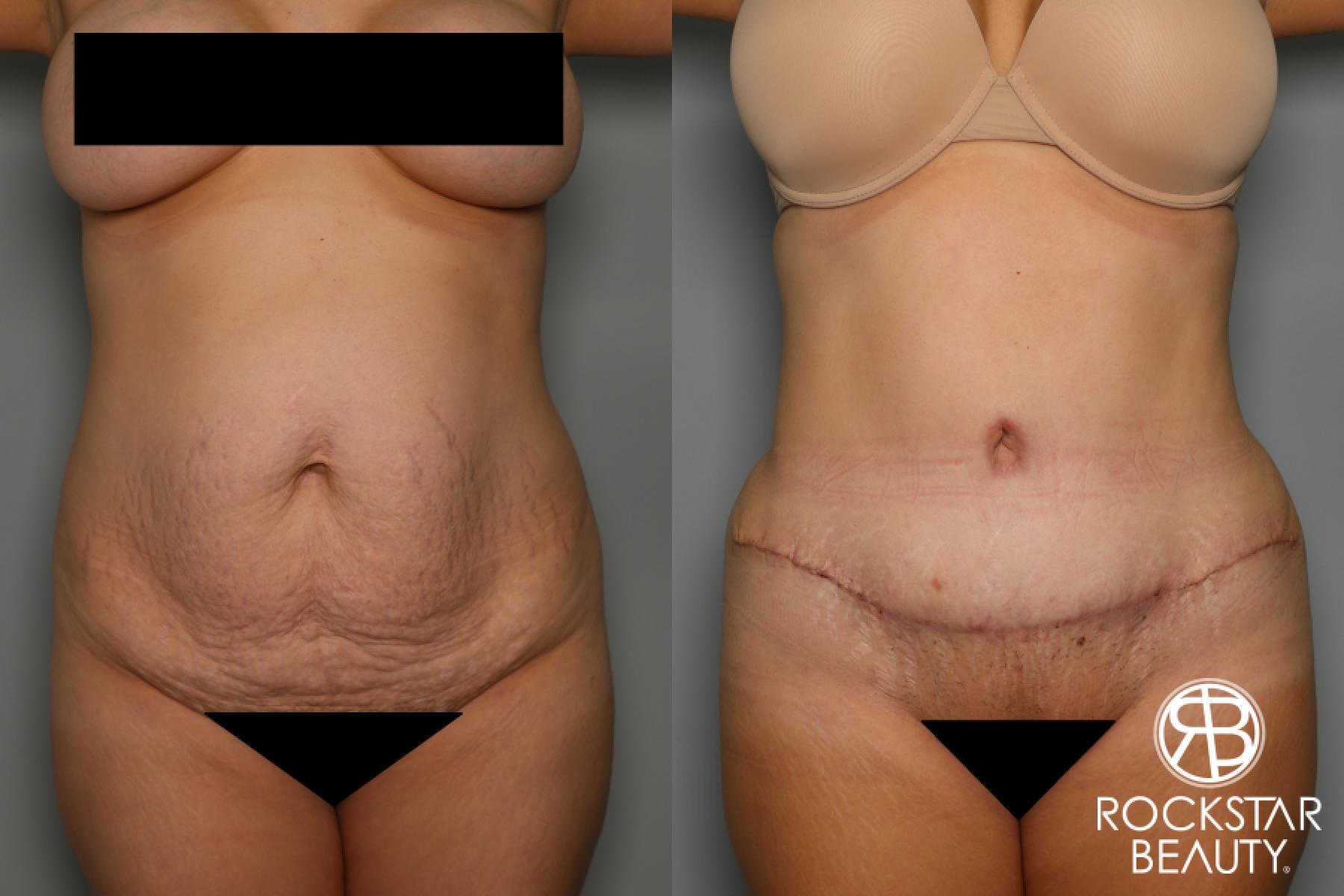 Tummy Tuck: Patient 20 - Before and After 1