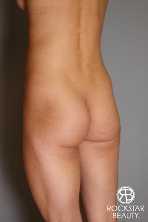 Butt Augmentation: Patient 3 - Before and After Image 5