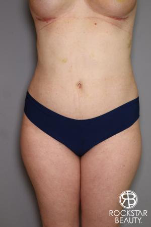 Liposuction: Patient 11 - After Image 1