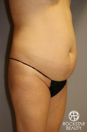 Tummy Tuck: Patient 1 - Before Image 2