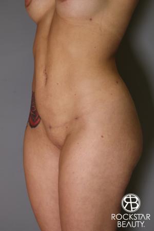 Brazilian Butt Lift: Patient 18 - After Image 4