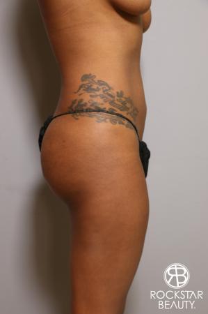 Liposuction: Patient 18 - Before and After Image 5