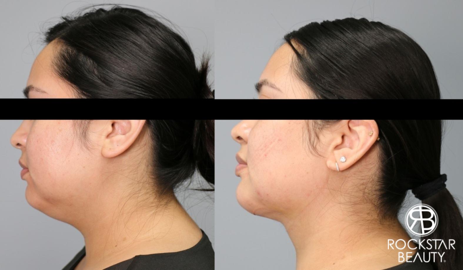 Liposuction Of The Neck: Patient 17 - Before and After 1