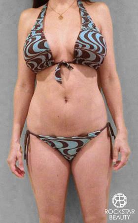Liposuction: Patient 8 - Before 1