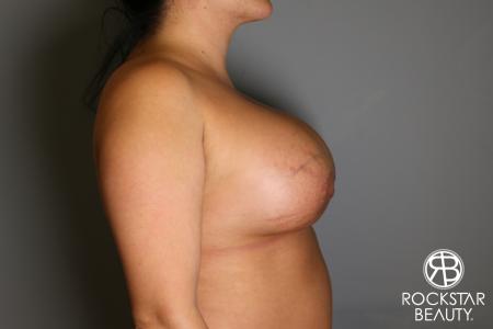 Breast Implant Exchange: Patient 1 - After Image 5