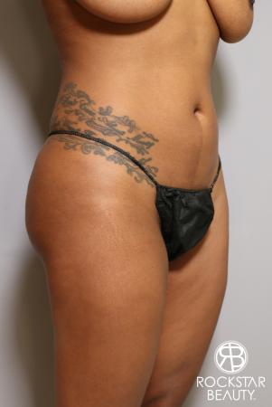 Brazilian Butt Lift: Patient 10 - Before Image 4