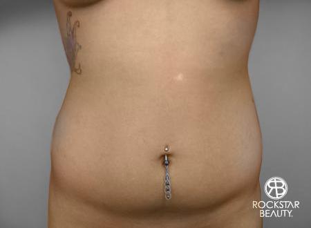 SmartLipo®: Patient 3 - Before Image 1