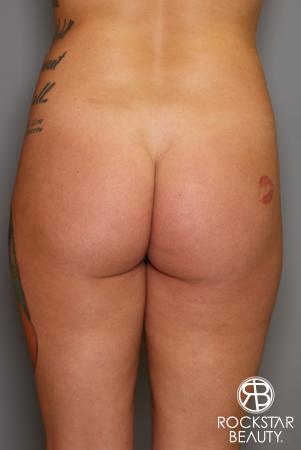 Brazilian Butt Lift: Patient 17 - Before Image 1