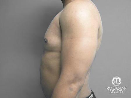 Liposuction: Patient 10 - After 5