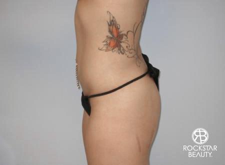 SmartLipo®: Patient 3 - After Image 3