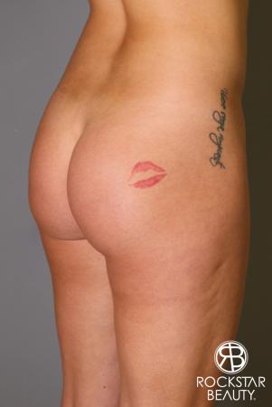Brazilian Butt Lift: Patient 17 - Before Image 2