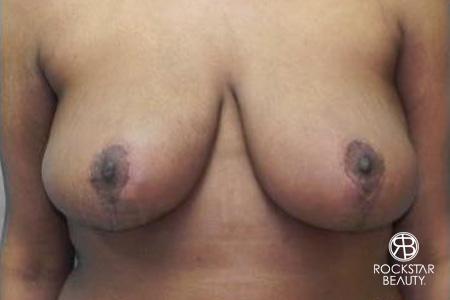 Breast Reduction: Patient 1 - After  