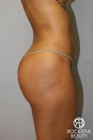 Brazilian Butt Lift: Patient 8 - After Image 2