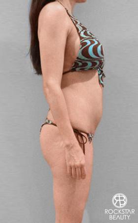 Liposuction: Patient 8 - Before 2