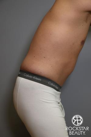 Tummy Tuck: Patient 5 - After Image 1