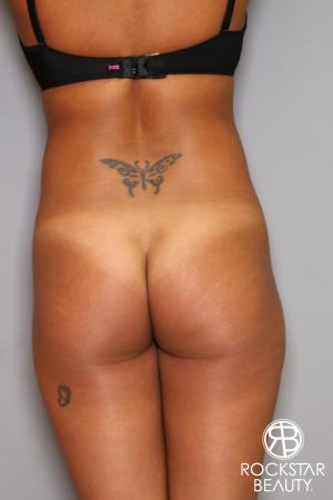 Brazilian Butt Lift: Patient 9 - Before Image 1