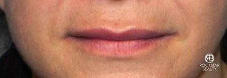 Lip Augmentation: Patient 1 - After Image 1