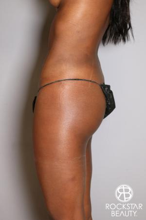 Liposuction: Patient 19 - After Image 5