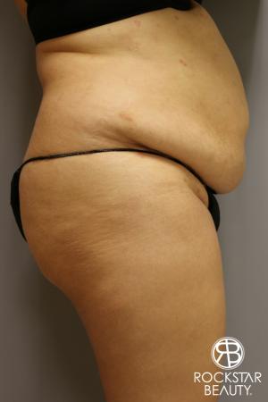 Tummy Tuck: Patient 2 - Before Image 3