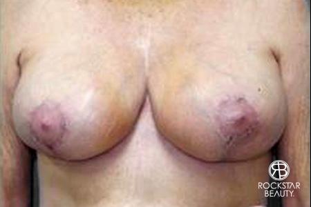 Breast Reduction: Patient 2 - After 1
