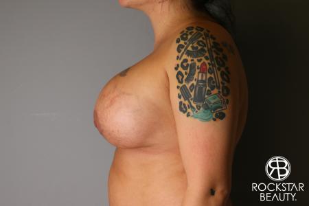 Breast Implant Exchange: Patient 1 - After Image 4