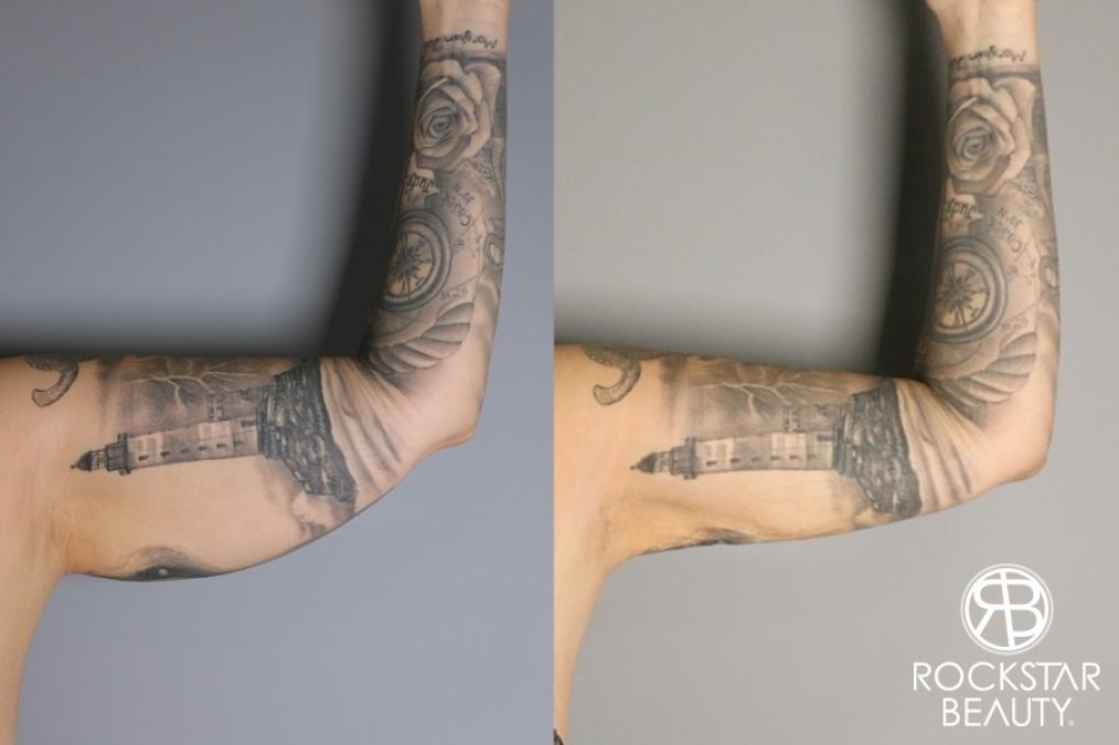 Liposuction: Patient 11 - Before and After 