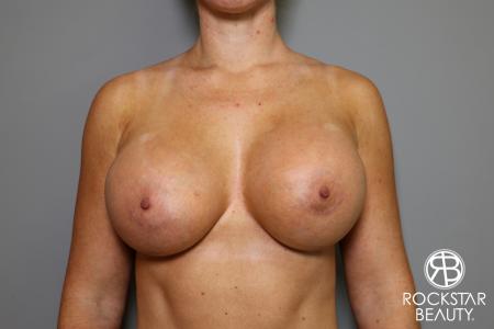 Breast Augmentation: Patient 15 - After Image 1