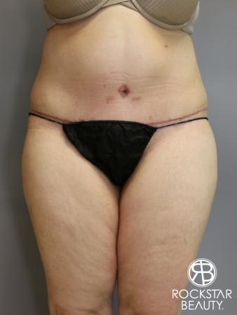 Tummy Tuck: Patient 4 - After Image 1
