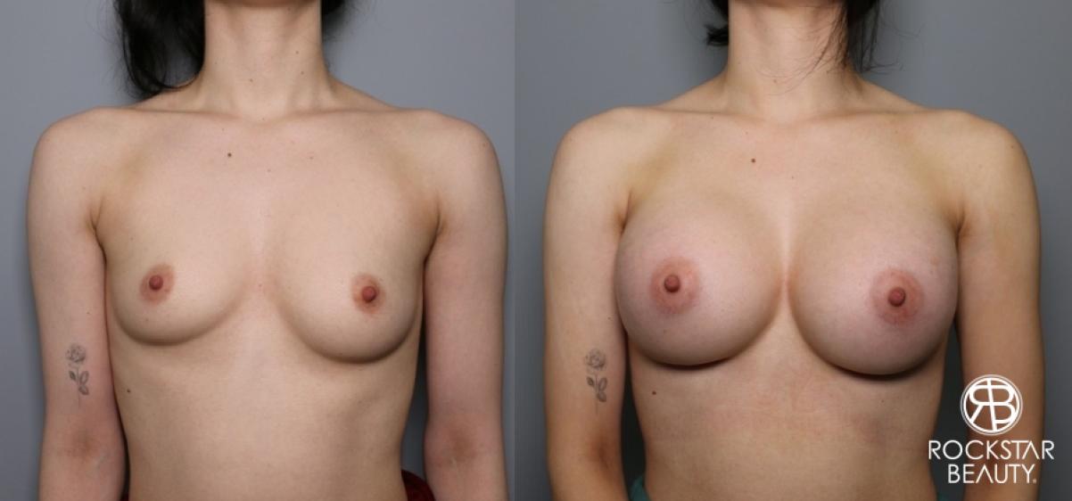 Breast Augmentation: Patient 12 - Before and After