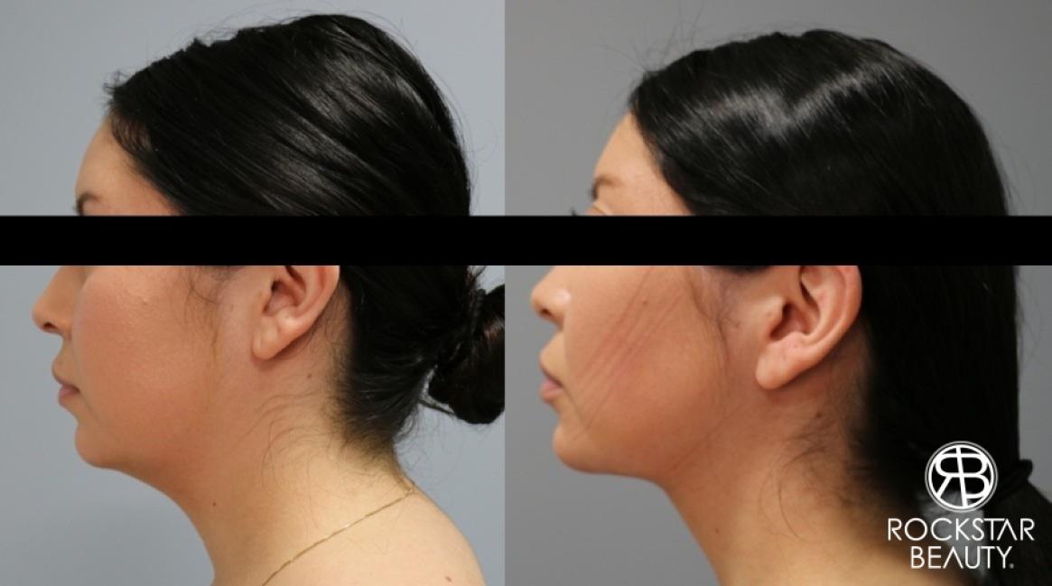 Liposuction Of The Neck: Patient 9 - Before and After  