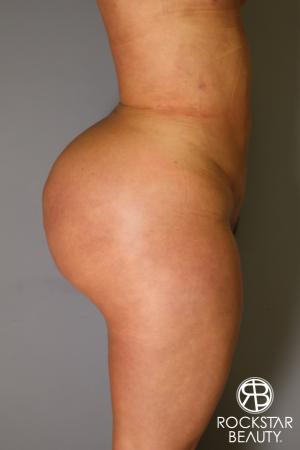 Brazilian Butt Lift: Patient 14 - After Image 3