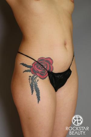 Brazilian Butt Lift: Patient 18 - Before and After Image 5