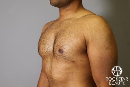 Liposuction: Patient 16 - After Image 2