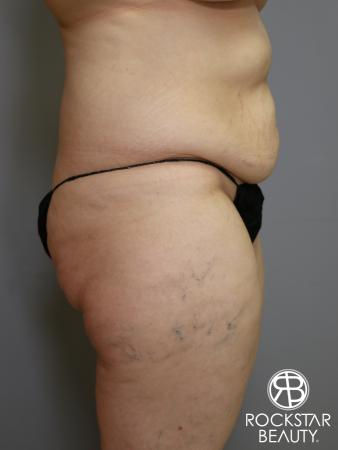 Tummy Tuck: Patient 4 - Before Image 3