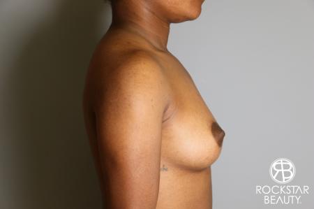 Breast Augmentation: Patient 10 - Before and After Image 3