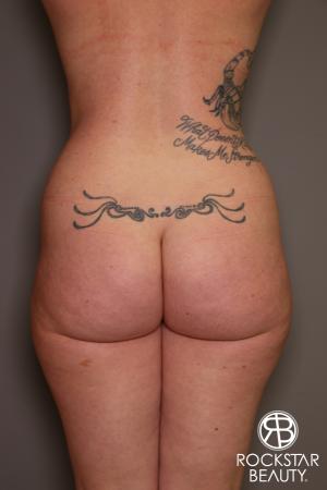 Brazilian Butt Lift: Patient 7 - Before Image 1