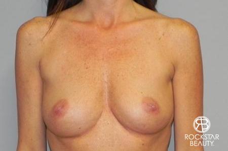 Breast Augmentation: Patient 5 - Before 