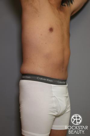 Tummy Tuck: Patient 5 - After Image 3