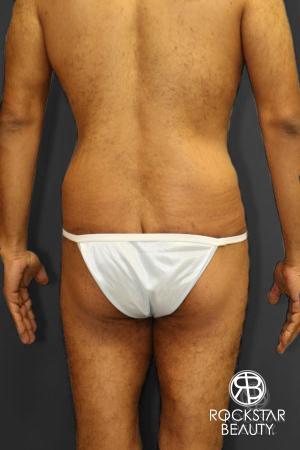 Body Lift: Patient 1 - After Image 4
