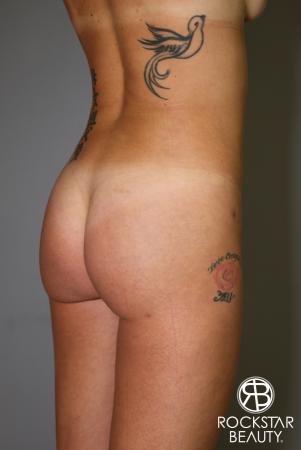 Brazilian Butt Lift: Patient 6 - After Image 2