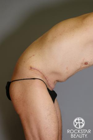 Tummy Tuck: Patient 11 - After Image 3