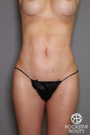 Liposuction: Patient 13 - After Image 1