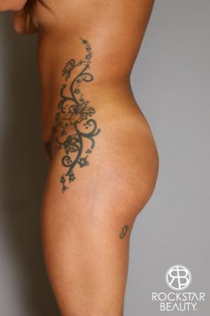 Brazilian Butt Lift: Patient 9 - After Image 3