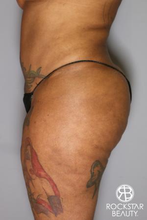 Brazilian Butt Lift: Patient 15 - Before Image 4
