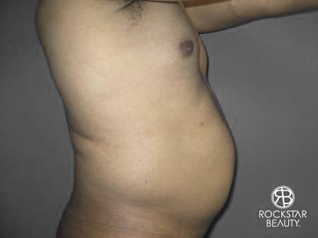 Liposuction: Patient 10 - Before 3