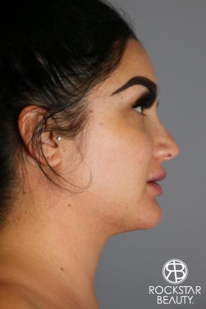 SmartLipo®-Face/Neck: Patient 2 - After Image 2