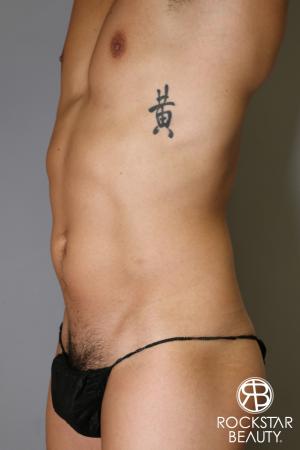 Liposuction: Patient 17 - Before Image 4