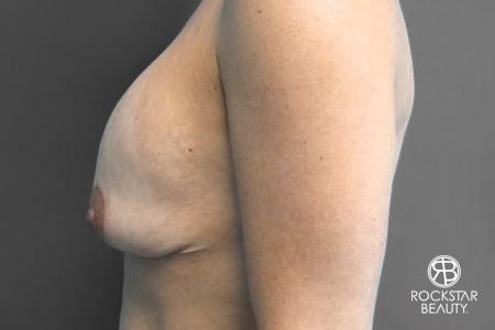 Breast Implant Exchange: Patient 2 - Before and After 3