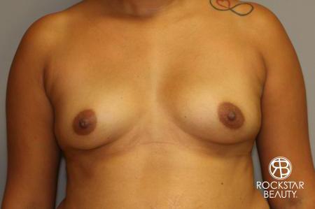Breast Augmentation: Patient 9 - Before 1
